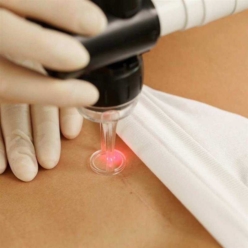 Scar removal treatment