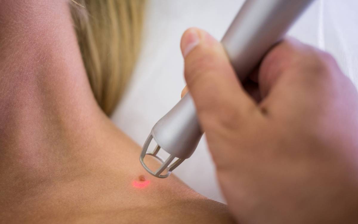 Mole Removal Services in Mohali: Safe, Advanced & Confidence-Boosting Skin Solutions